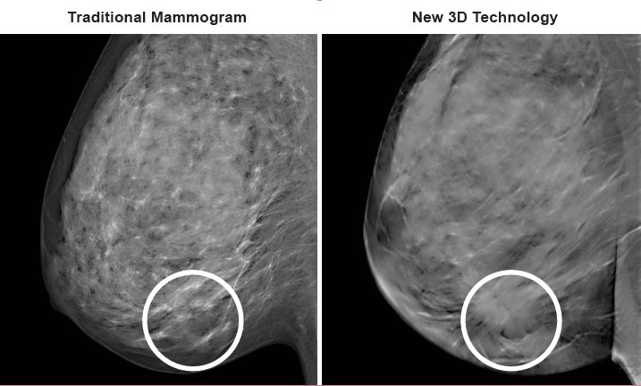 3d Mammography Exams In St Louis Watson Imaging Center 